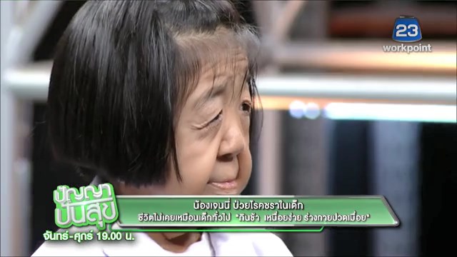 โรคชราในวัยเด็ก