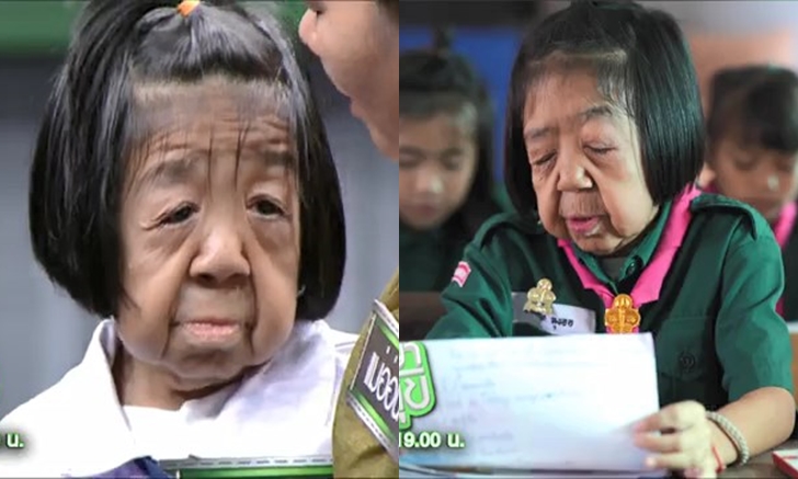 โรคชราในวัยเด็ก