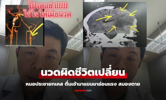 หมอประชา ยกเคส "อย่าไว้ใจให้เมียนวด" ตื่นเช้ามาแขนขาอ่อนแรง สมองตาย