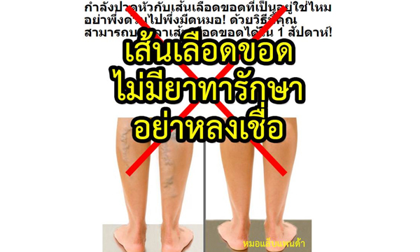 แพทย์ยัน! “เส้นเลือดขอด” ทายาไม่หาย!