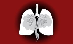 พฤติกรรมเสี่ยง “มะเร็งปอด” แม้ไม่สูบบุหรี่