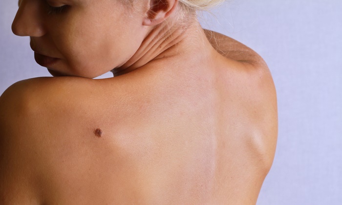 skin-cancer-2.jpg