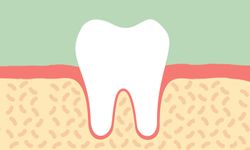 4 สัญญาณอันตราย ได้เวลารักษา “รากฟัน”