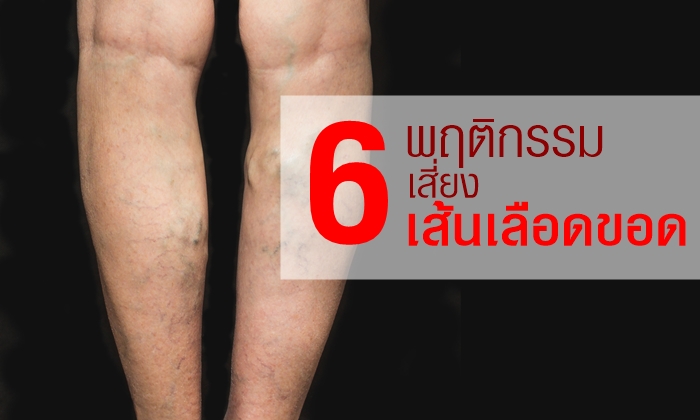 6 พฤติกรรมเสี่ยง “เส้นเลือดขอด” ที่คุณอาจไม่ทราบมาก่อน