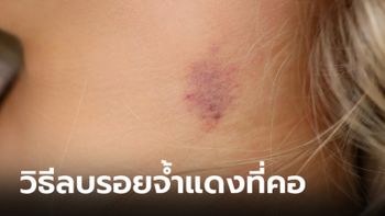 วิธีลบรอยจ้ำแดง รอยจูบ ที่ถูกฝากไว้ที่คอ ให้จางหายอย่างรวดเร็ว