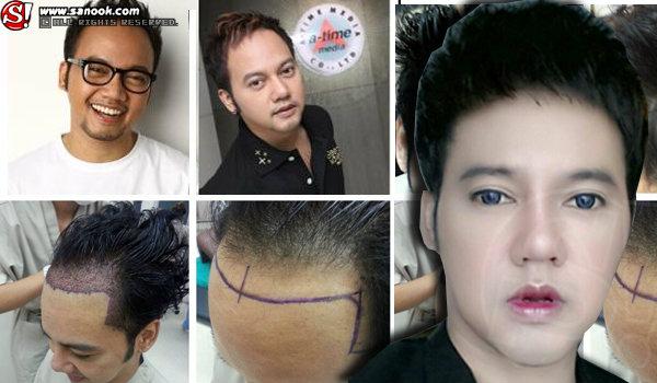 ศัลยกรรมผู้ชาย