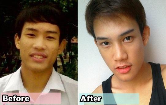 ศัลยกรรมปากบาง