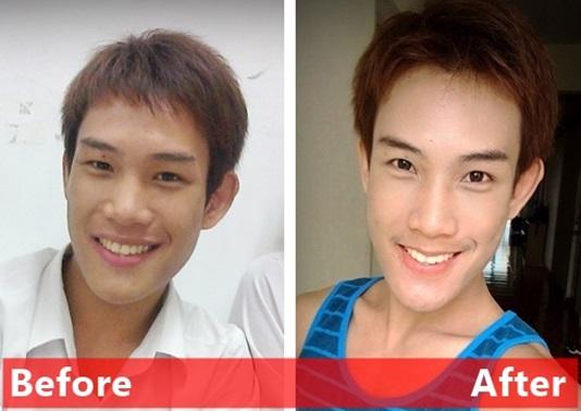 ศัลยกรรมปากบาง