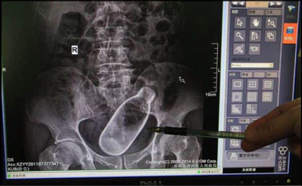 ยัดขวดเข้าทวาร