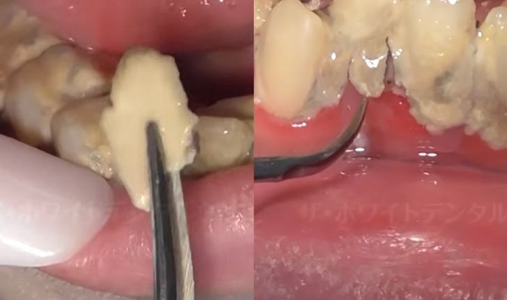 หมอฟันญี่ปุ่นอึ้ง เจอ "โคตรหินปูน" ในช่องปากคนไข้สาววัย 25 บางชิ้นใหญ่กว่าฟัน