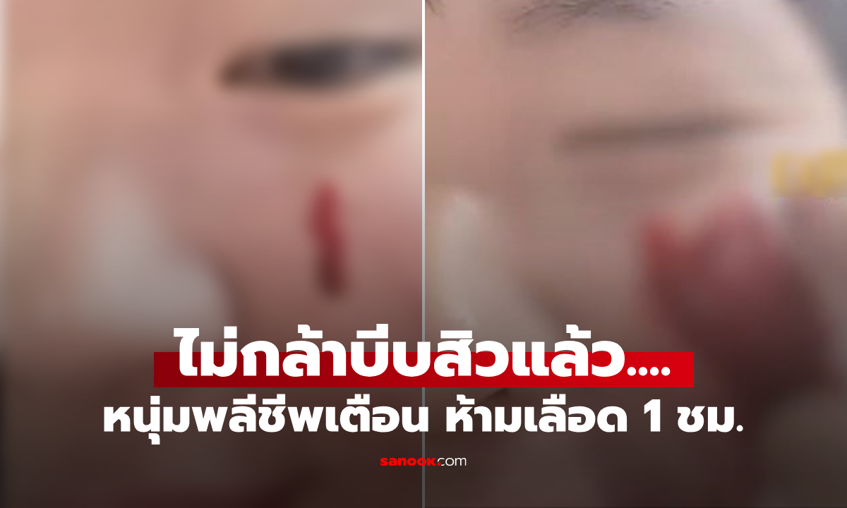 เป็นเรื่อง! หนุ่มรีวิว "แค่บีบสิว" ต้องห้ามเลือด 1 ชม.ไหลไม่หยุด ใช้ทิชชู่ 400 แผ่น ใครดูก็สยอง