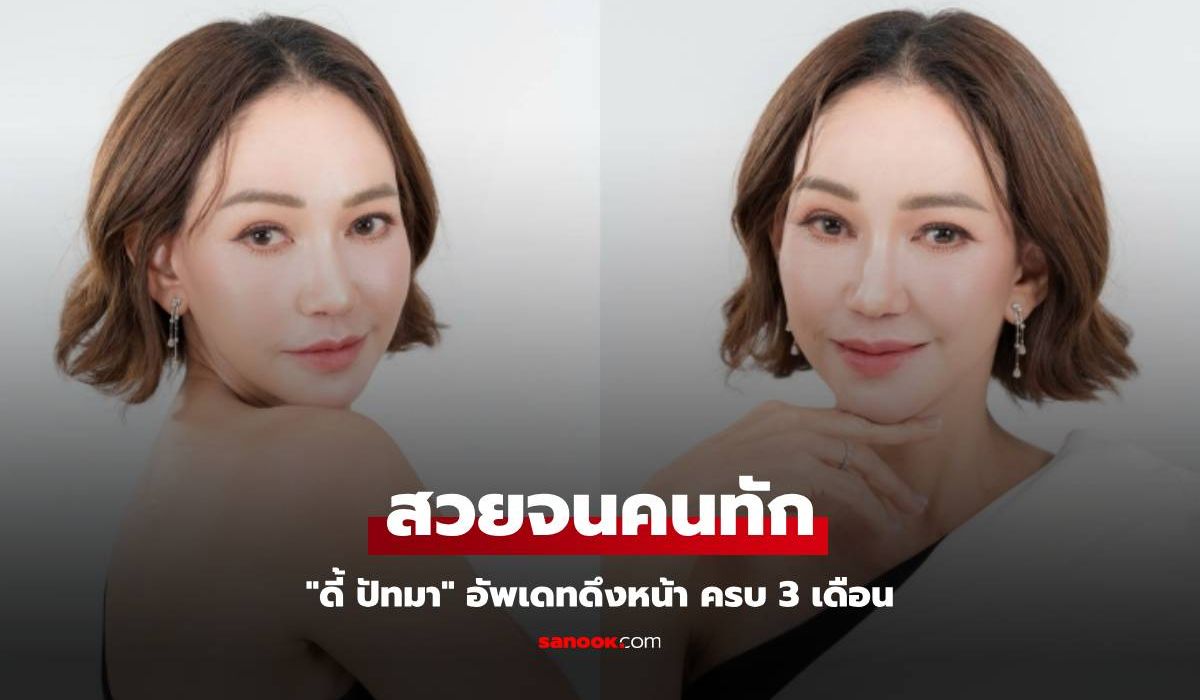 "ดี้ ปัทมา" อัพเดทดึงหน้า ครบ 3 เดือน สวยจนคนทัก