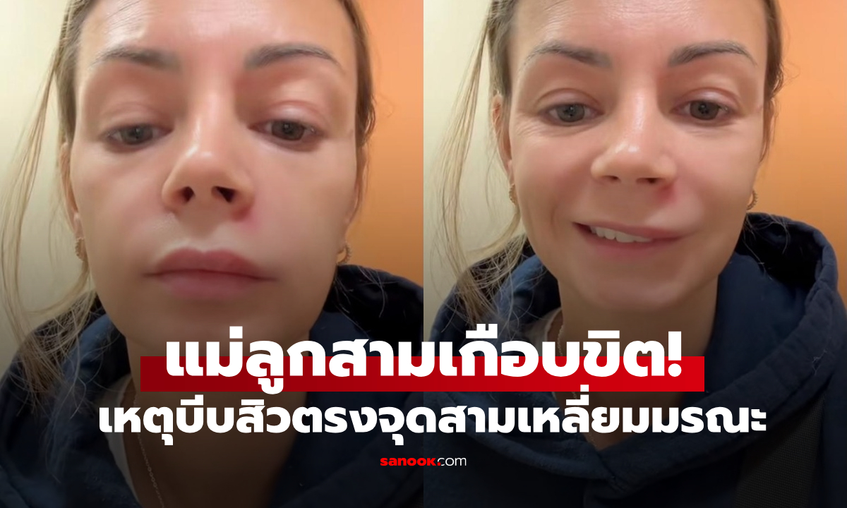 แม่ลูก 3 แชร์อุทาหรณ์! พลาดบีบสิวตรงจุด "สามเหลี่ยมมรณะ" ถูกหามส่ง รพ.ด่วน