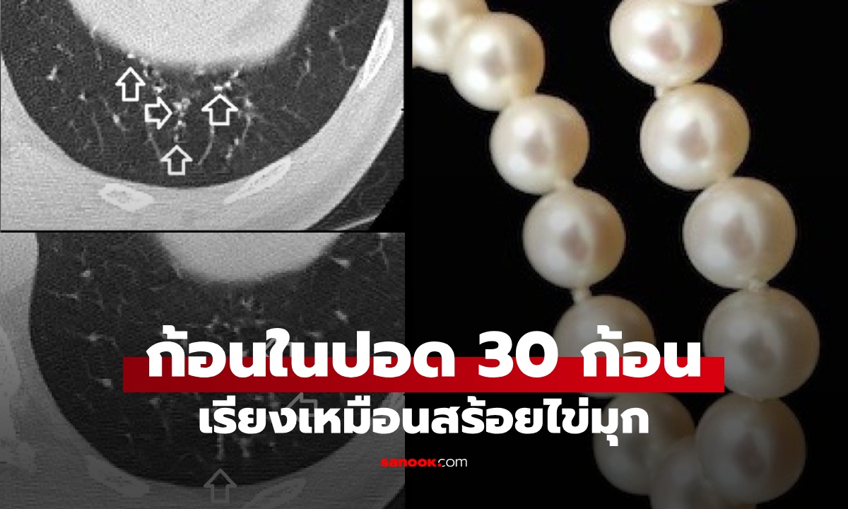 นึกว่ามะเร็ง เจอก้อนในปอด 30 ก้อน เรียงเหมือนสร้อยไข่มุก เซอร์ไพรส์คำตอบหมอ