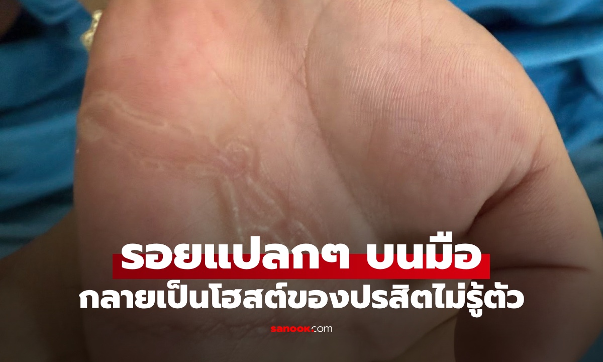 เด็กชาย 4 ขวบ มีรอยแปลกๆ บนฝ่ามือ รู้สาเหตุแล้วขนลุก ที่อยู่ใหม่ปรสิต!
