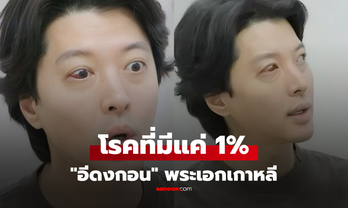 พระเอกดัง "อีดงกอน" ป่วยโรคหายาก ที่มีเพียง 1% ของประชากรเกาหลีใต้!