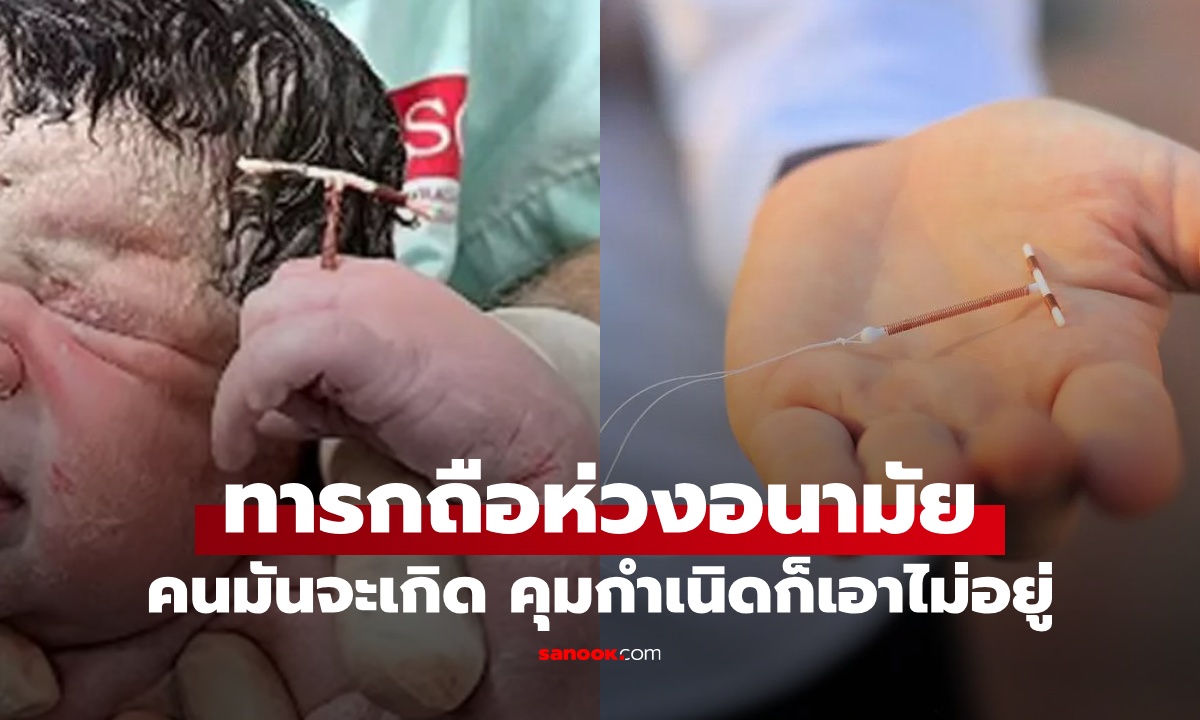 ทารกคลอดพร้อม "ห่วงอนามัย" ถือตอกย้ำชัยชนะ คนมันจะเกิดคุมกำเนิดก็เอาไม่อยู่!