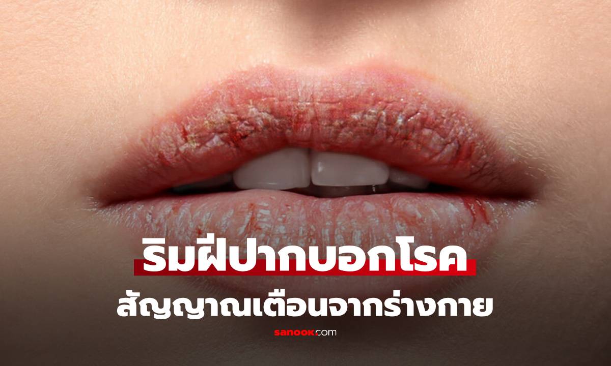 เช็กเองง่ายๆ "สีริมฝีปาก" บอกโรคได้ สัญญาณจากร่างกายที่ไม่ควรมองข้าม