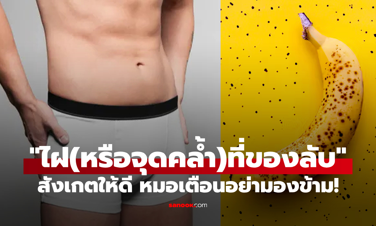 "ไฝบนอวัยวะเพศ" หมอเตือนอย่ามองข้าม เผยวิธีสังเกตและการดูแล