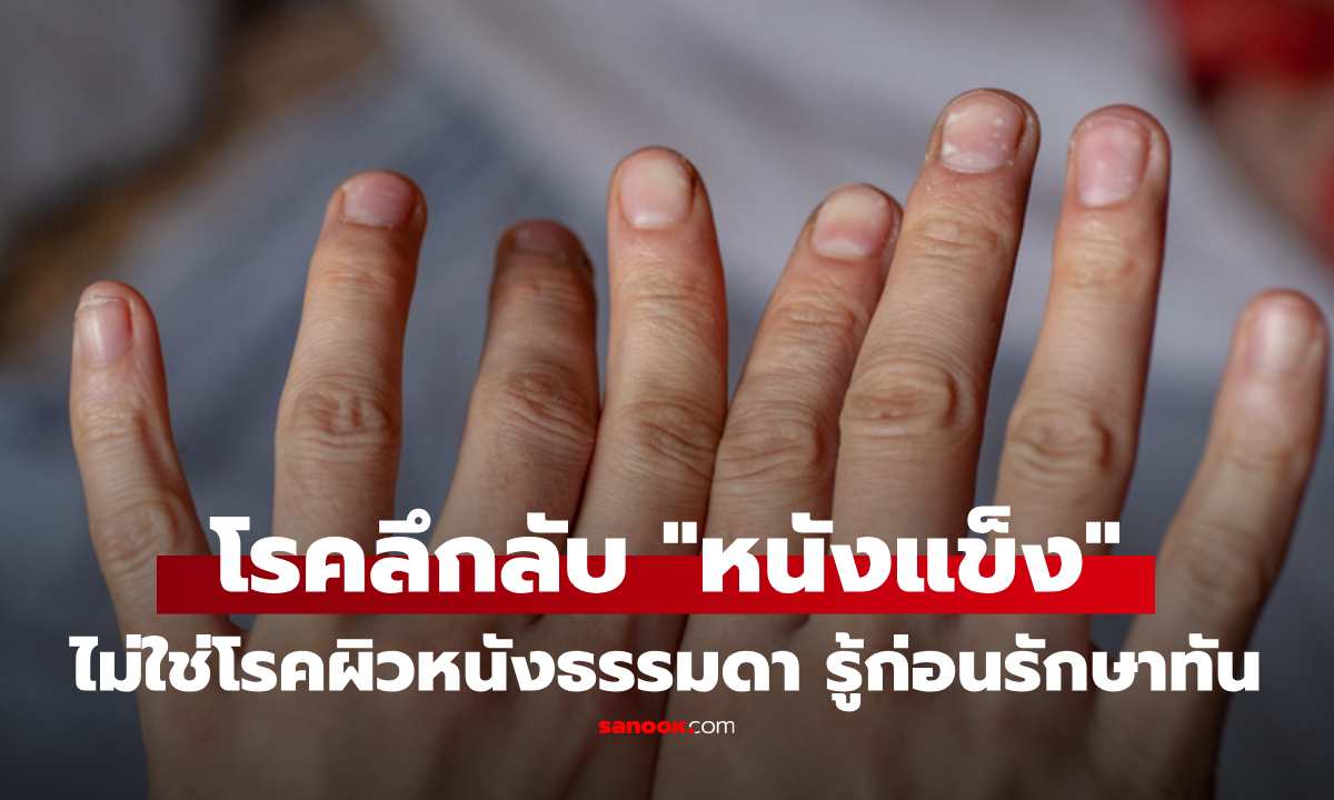 "โรคหนังแข็ง" คืออะไร? โรคลึกลับที่ไม่ใช่แค่เรื่องผิวหนัง แต่ทำลายทุกระบบร่างกาย