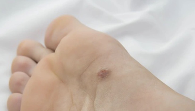 เอะใจรอยแปลกๆ ที่ฝ่าเท้า หนุ่มรีบทำ “สิ่งนี้” แพทย์รู้ยังชม ช่วยให้พบมะเร็งตั้งแต่ระยะแรก!