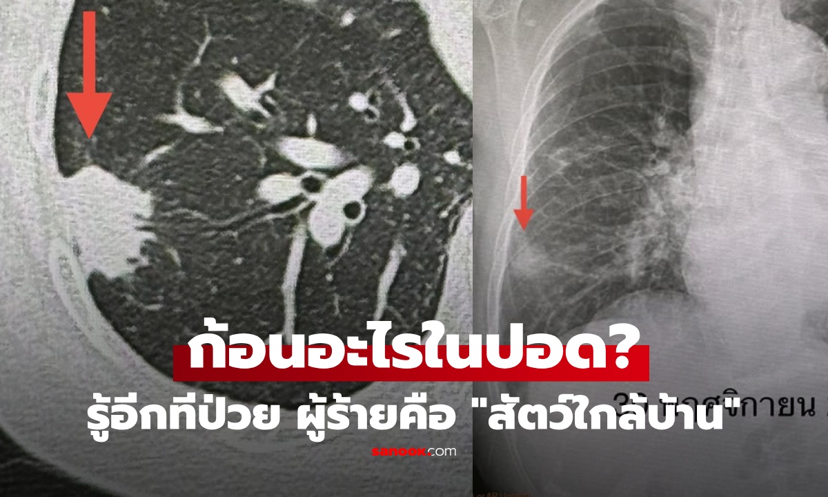 หมอแชร์เคส หญิงสุขภาพดูปกติ แต่เอกซเรย์พบ "ก้อนปริศนา" อึ้ง ที่แท้ผู้ร้ายคือ "สัตว์ใกล้บ้าน"