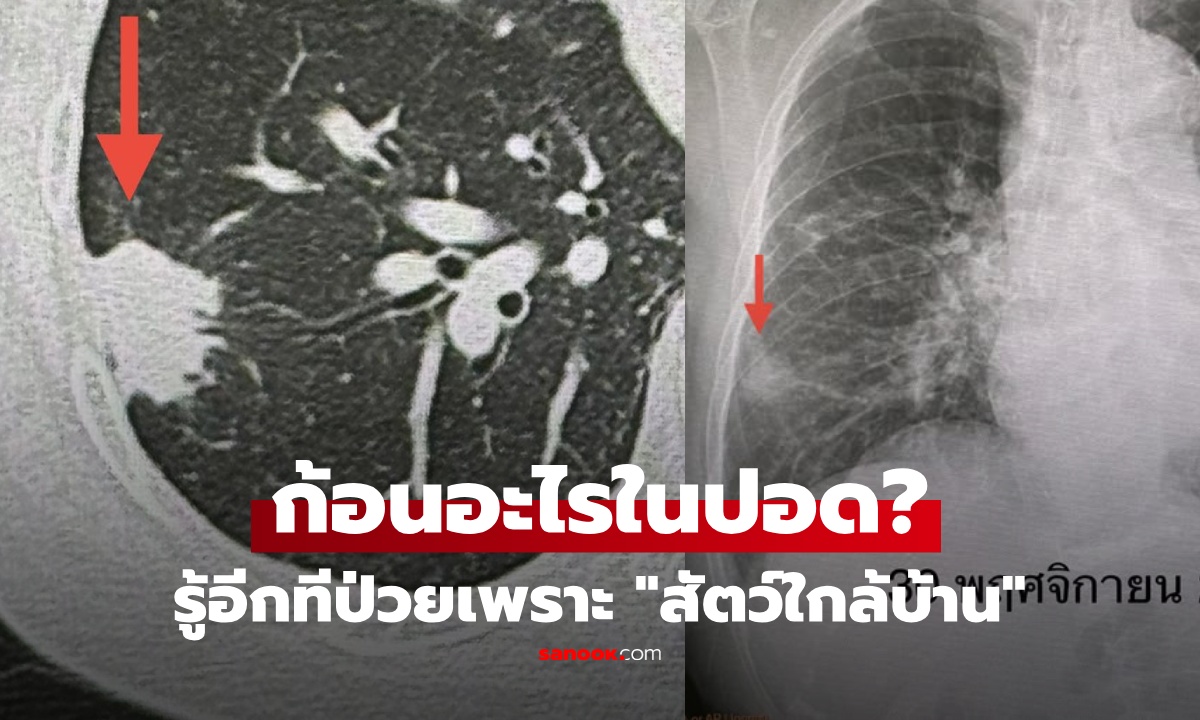 มันมาโดยไม่รู้ตัว! หมอแชร์เคสหญิงมี "ก้อนในปอด" ไม่สูบบุหรี่ ไม่ไอ พบผู้ร้ายคือ "สัตว์ใกล้บ้าน"