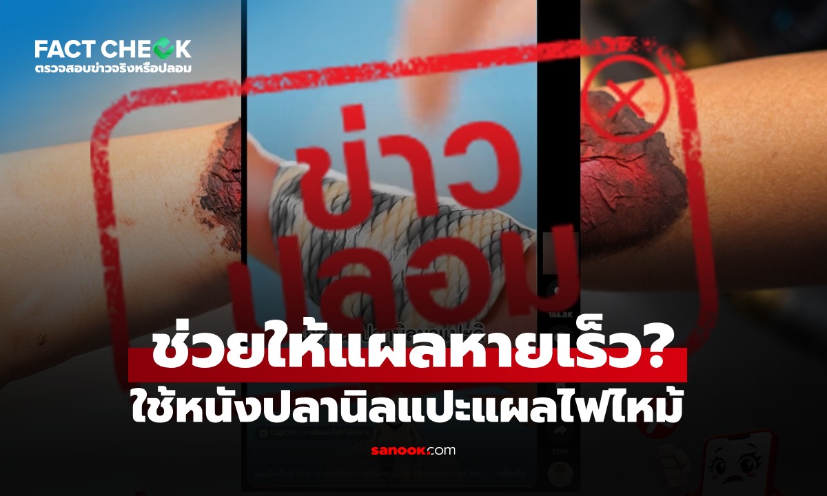 ใช้หนังปลานิลแปะแผลไฟไหม้ ช่วยให้แผลหายเร็ว จริงหรือไม่? : เช็กข่าวชัวร์