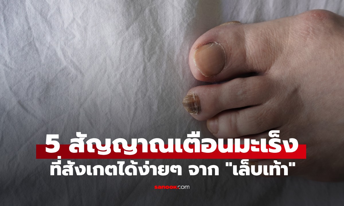 แพทย์เตือน สัญญาณเตือนมะเร็ง ที่ซ่อนอยู่ใต้ "เล็บเท้า" อาการเล็กๆ ที่ไม่ควรมองข้าม