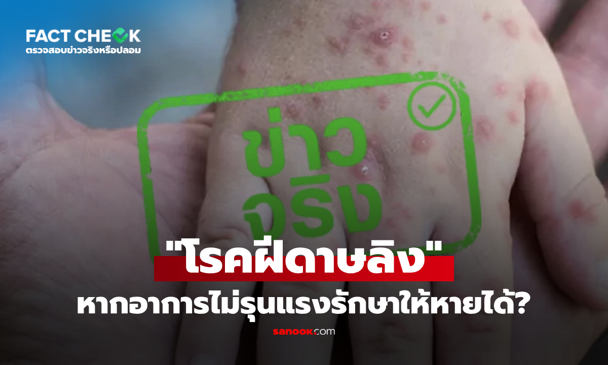 โรคฝีดาษลิง ติดจากการสัมผัสใกล้ชิด หากอาการไม่รุนแรงรักษาให้หายได้? : เช็กข่าวชัวร์