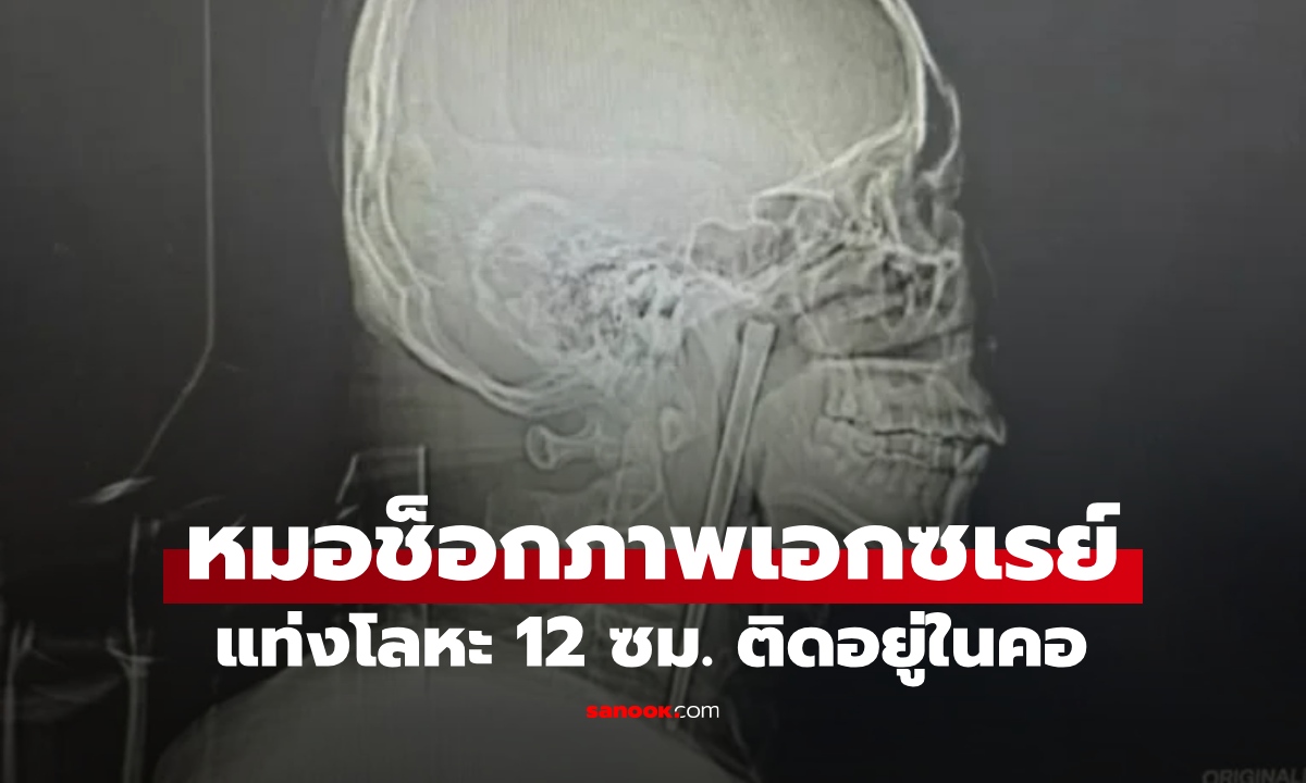 ภาพทีมแพทย์ช็อกภาพเอกซเรย์ แท่งโลหะยาว 12 ซม. ติดอยู่ในลำคอคนไข้มานาน 8 ปี!