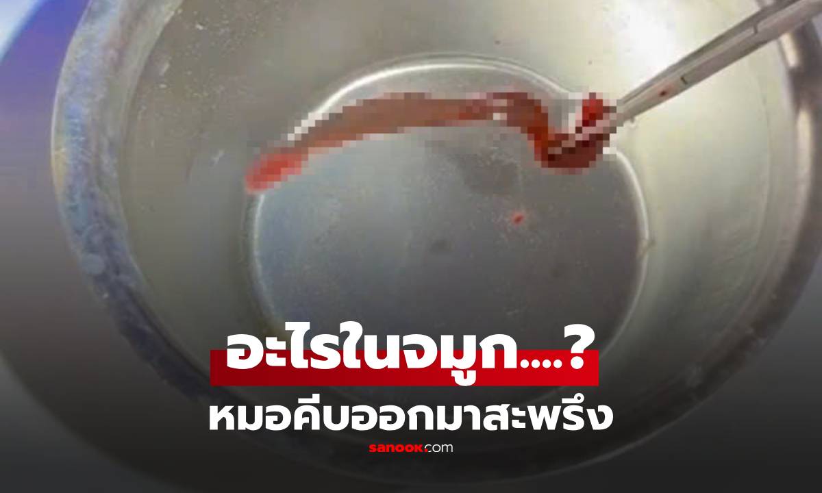 สยองเกล้า! หนุ่มเลือดกำเดาไหล 3 วัน หมอคีบ "สิ่งนี้" ออกจากจมูก ตัวเป้ง 5 ซม.