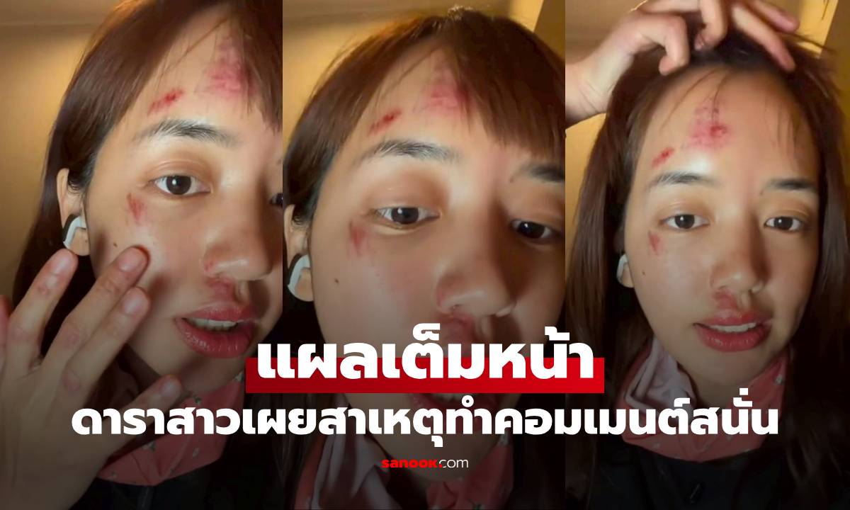 เห็นแล้วตกใจ! ดาราสาวแผลเต็มหน้า หลังล่องเรือขั่วโลก สาเหตุทำคอมเมนต์สนั่น