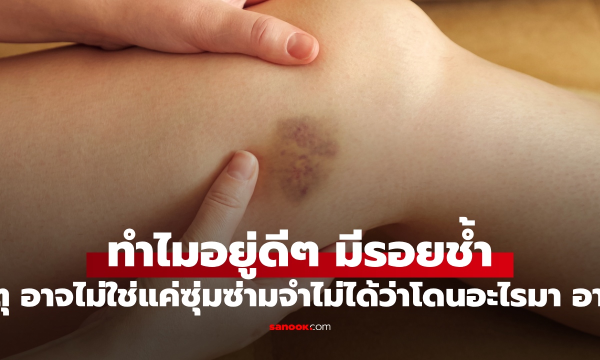 เปิด 4 สาเหตุ ทำไมอยู่ดีๆ ถึงมีรอยช้ำตามตัว จำไม่ได้ว่าโดนอะไรมา อาจไม่ใช่แค่ซุ่มซ่าม