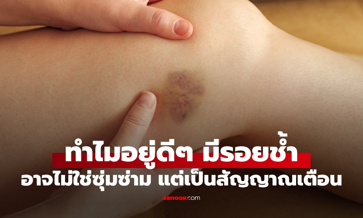 เปิด 4 สาเหตุ ทำไมอยู่ดีๆ ถึงมีรอยช้ำตามตัว ไม่รู้ว่าโดนอะไร อาจไม่ใช่แค่ซุ่มซ่าม