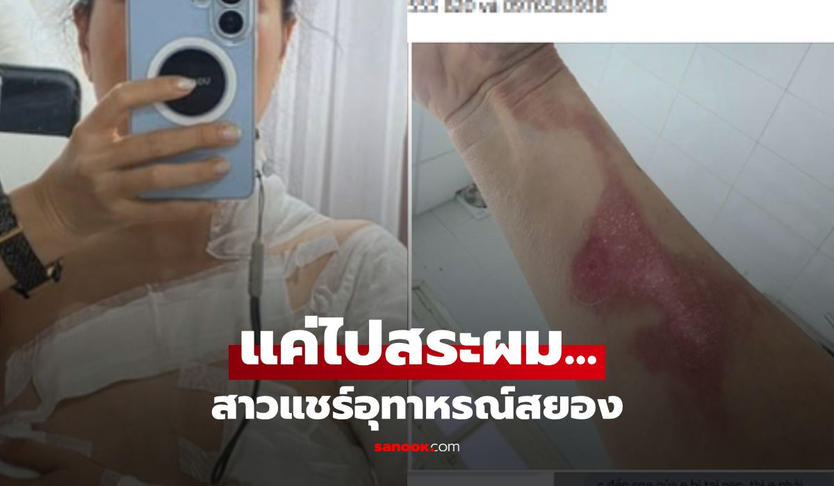 สาวเข้าร้าน "สระผม" หวังผ่อนคลาย สุดท้ายได้แผลไหม้เสียโฉม ต้องหามส่งหมอด่วน!