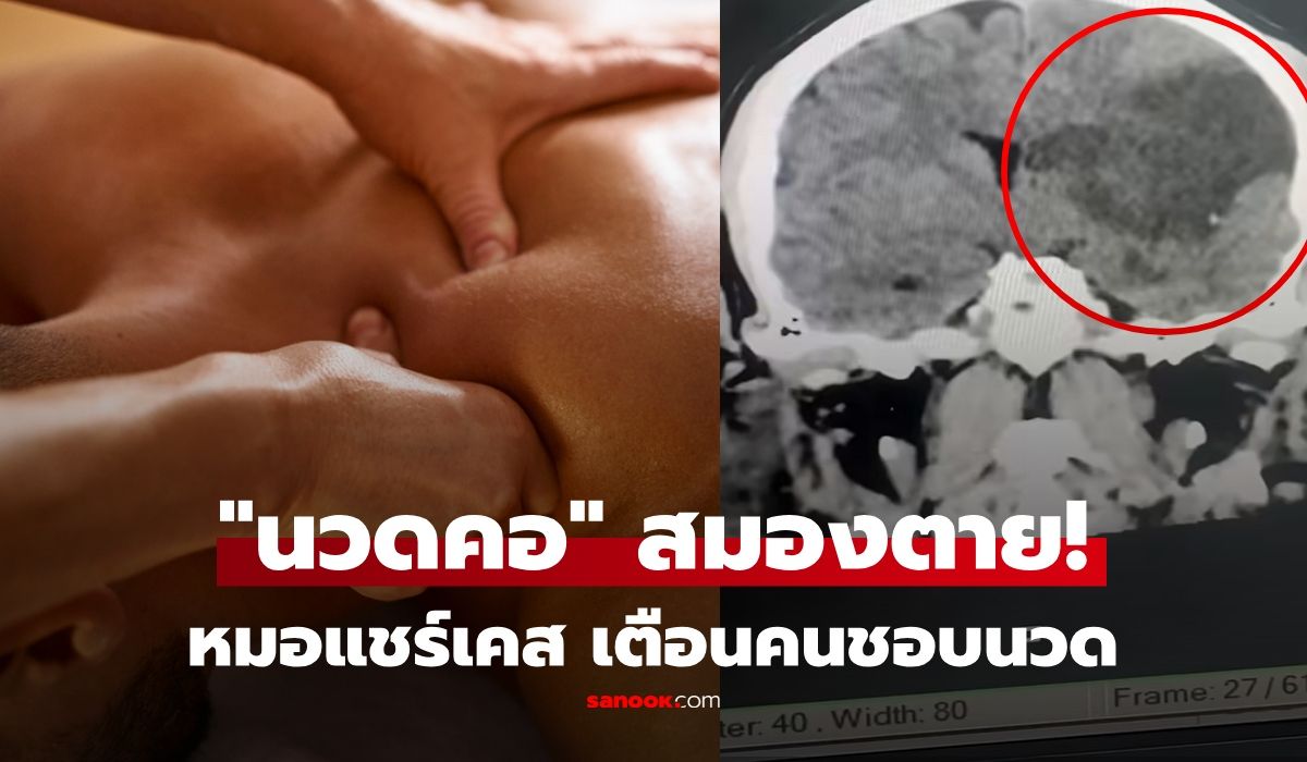 อย่าไว้ใจเมีย! หมอแชร์เคส ชายให้เมีย "นวดคอ" สุดท้ายสมองตาย ชี้จุดอันตรายกดผิด ถึงชีวิต