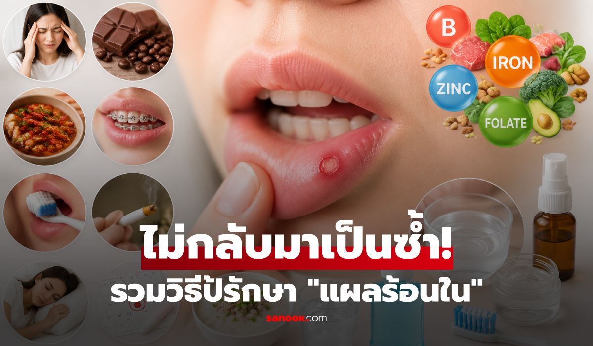 "แผลร้อนใน" เกิดจากอะไร? รวมวิธีป้องกัน-รักษาให้หายไว ไม่กลับมาเป็นซ้ำ!