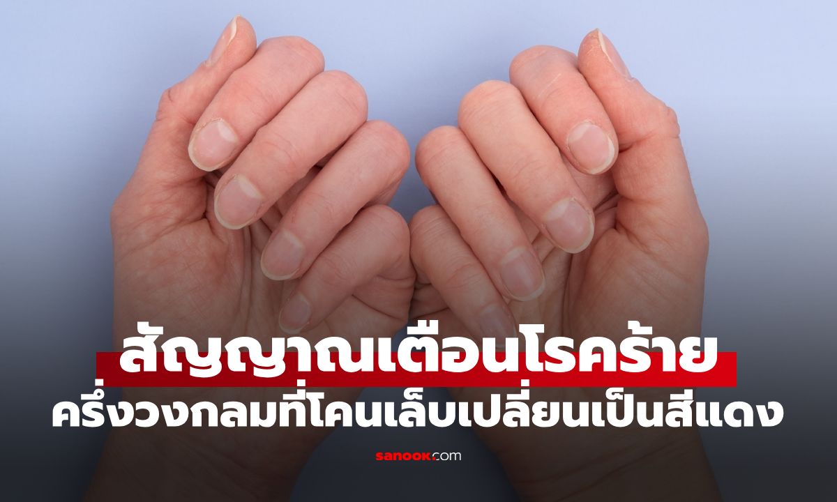 สังเกตด่วน! "ครึ่งวงกลมที่โคนเล็บ" ถ้าเปลี่ยนเป็นสีแดง สัญญาณเตือนที่ไม่ควรมองข้าม