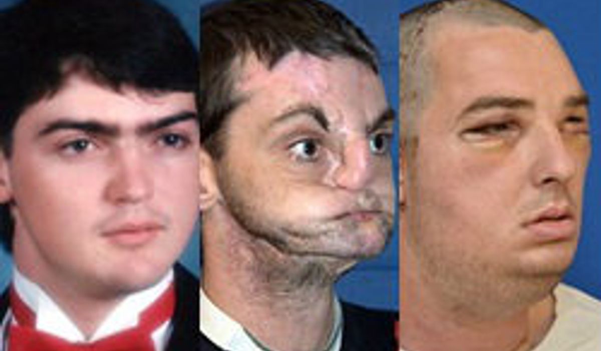 ชีวิตใหม่หนุ่มสหรัฐ! หมอผ่าตัดปลูกถ่ายใบหน้าสำเร็จ