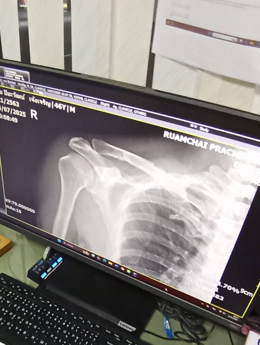 สุดทน  ฝาบ่อมหาภัย ทำชาวบ้าน สาหัส