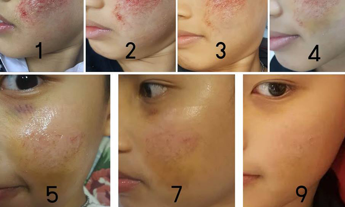 วิธีดูแลแผลบนหน้าลูก หายได้ใน 9 วัน