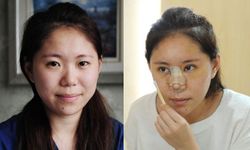 สาวจีนวัย 25 แชร์ประสบการณ์ศัลยกรรมหน้าใหม่ 7 ชั่วโมง 5 รายการ
