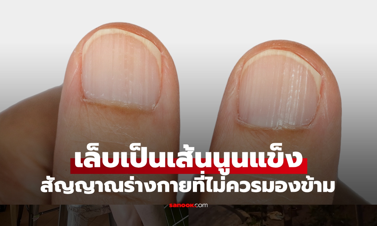 เป็นกันอยู่ไหม? เล็บนูนเป็นเส้นแข็ง สัญญาณบอกอะไร เตือนดังๆ อย่ามองข้ามเด็ดขาด