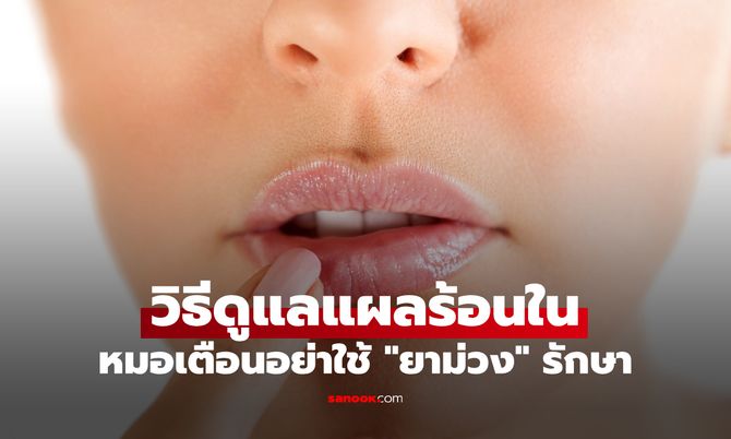 แผลร้อนในแสบจนกินข้าวไม่ได้! หมอเตือนอย่าใช้ "ยาม่วง" รักษาแผลร้อนใน