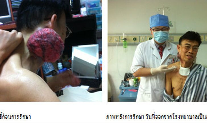 ผู้ป่วยมะเร็งชาวไทย ร่วมแชร์ประสบการณ์การไปรักษา ณ โรงพยาบาลมะเร็งสมัยใหม่กว่างโจว