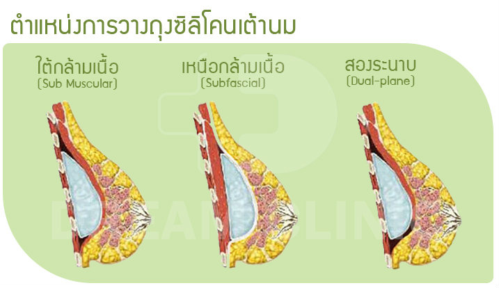 รีวิว : เสริมหน้าอกเพิ่มความมั่นใจ! เติมเต็มความเป็นผู้หญิง