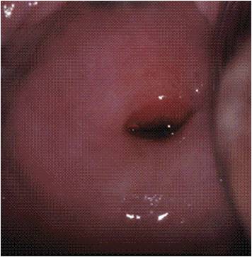 ไม่ใช่กลุ่มเสี่ยง แต่ทำไมถึงเป็น มะเร็งปากมดลูก