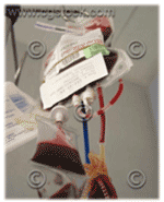 มะเร็งเม็ดเลือดขาว - ลิวคีเมีย, ลูคีเมีย, Leukemia