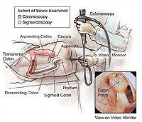 มะเร็งลำไส้ใหญ่